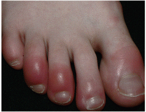 toes afflicted with chilblains
